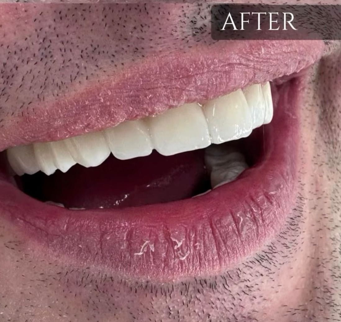 Hollywood smile — estetski rezultat